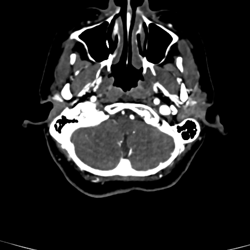 Cerebral arteriovenous malformation (Radiopaedia 73830-84645 Axial C+ delayed 83).jpg