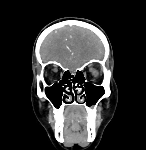 Cerebral arteriovenous malformation (Radiopaedia 73830-84645 C 21).jpg