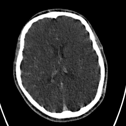 Cerebral arteriovenous malformation (Radiopaedia 78188-90746 Axial C+ delayed 102).jpg