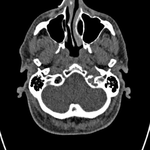 Cerebral arteriovenous malformation (Radiopaedia 78188-90746 Axial non-contrast 23).jpg