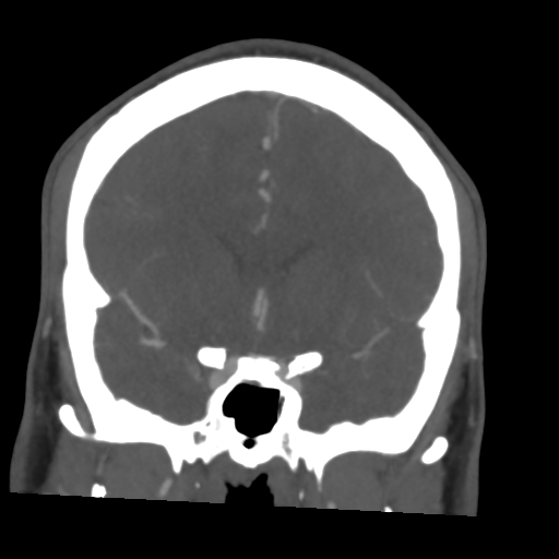 Cerebral arteriovenous malformation (Spetzler-Martin grade 2) (Radiopaedia 41262-44076 F 24).png