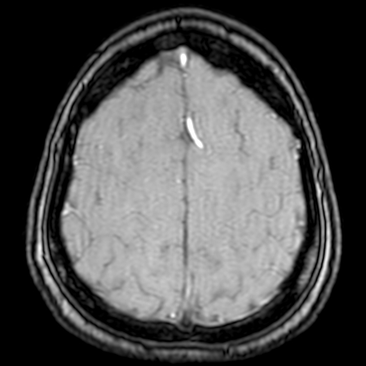 Cerebral arteriovenous malformation at posterior body of corpus callosum (Radiopaedia 74111-84925 Axial MRA 186).jpg