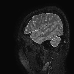 Cerebral arteriovenous malformation at posterior body of corpus callosum (Radiopaedia 74111-84925 Sagittal T2 14).jpg
