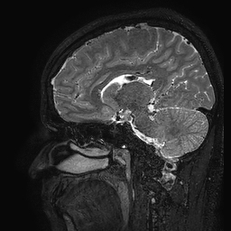 Cerebral arteriovenous malformation at posterior body of corpus callosum (Radiopaedia 74111-84925 Sagittal T2 77).jpg