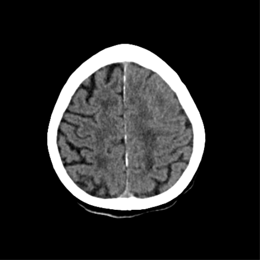 File:Cerebral arteriovenous malformation with lobar hemorrhage (Radiopaedia 44725-48510 Axial non-contrast 32).png