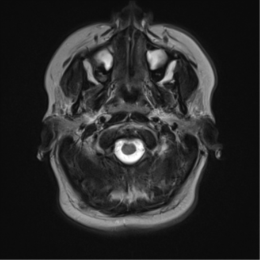 File:Cerebral cavernoma and development venous anomaly (Radiopaedia 37603-39482 Axial T2 1).png