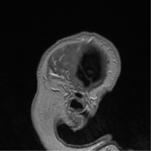 Cerebral cavernoma and development venous anomaly (Radiopaedia 37603-39482 Sagittal T1 C+ 9).png