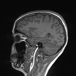 File:Cerebral cavernous venous malformation (Radiopaedia 70008-80021 Sagittal T1 51).jpg