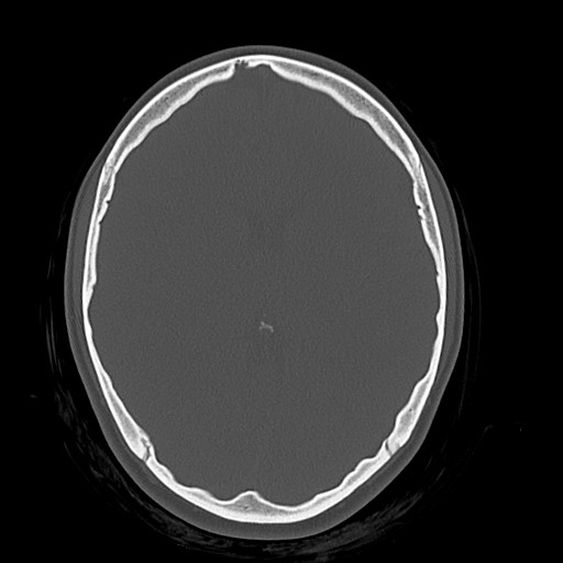 Cerebral cavernous venous malformation (Radiopaedia 70008-80022 Axial bone window 26).jpg