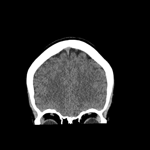 Cerebral cavernous venous malformation (Radiopaedia 70008-80022 non-contrast 17).jpg