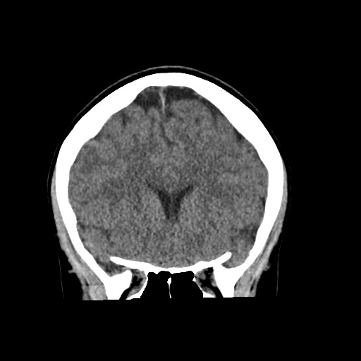 Cerebral cavernous venous malformation (Radiopaedia 70008-80022 non-contrast 25).jpg