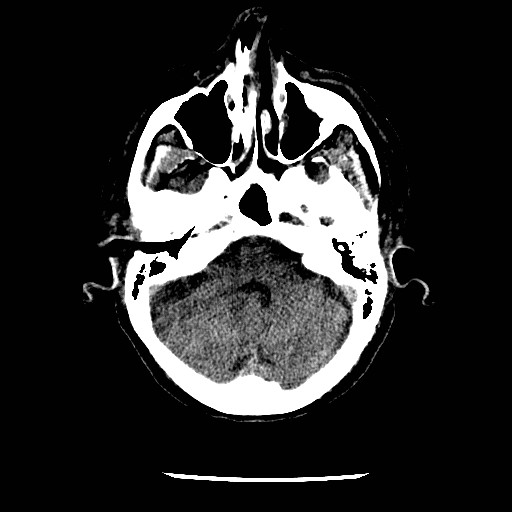 File:Cerebral edema (evolution in time) (Radiopaedia 19418-19441 non-contrast 26).jpg