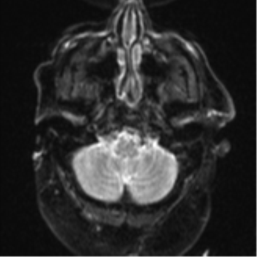 File:Cerebral embolic infarcts (embolic shower) (Radiopaedia 57395-64342 Axial DWI 6).png