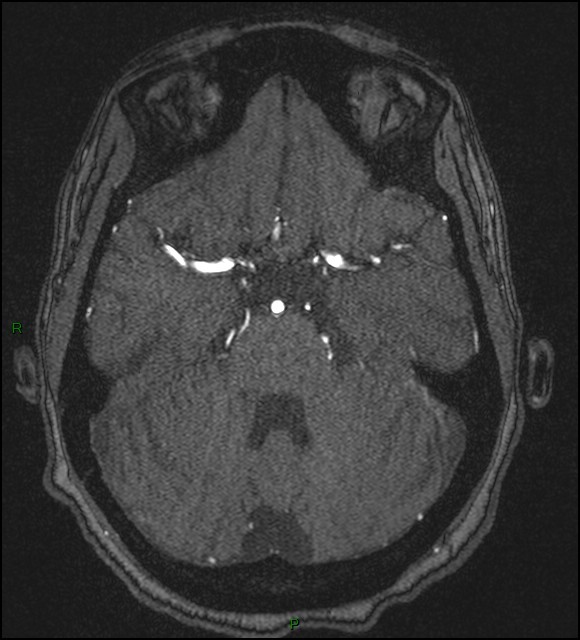 Cerebral fat embolism (Radiopaedia 35022-36525 Axial TOF 63).jpg