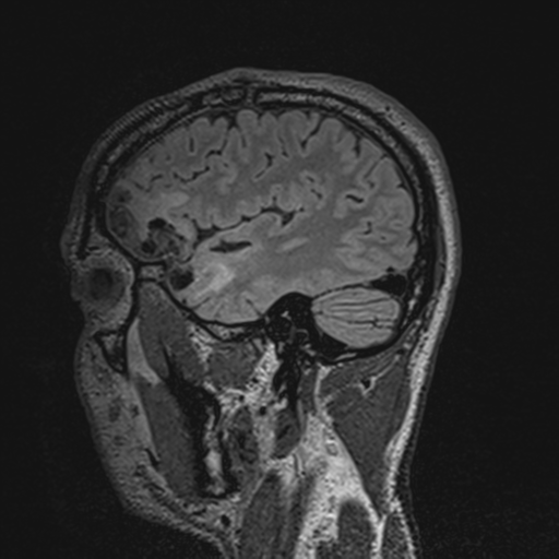 File:Cerebral hemorrhagic contusions. temporal evolution (Radiopaedia 40224-42757 Sagittal 44).png