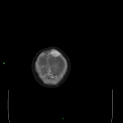 Cerebral metastases - breast primary (Radiopaedia 77653-89857 Axial bone window 117).jpg