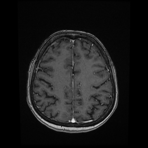 Cerebral metastases - melanoma (Radiopaedia 80972-94522 Axial T1 C+ 69).jpg
