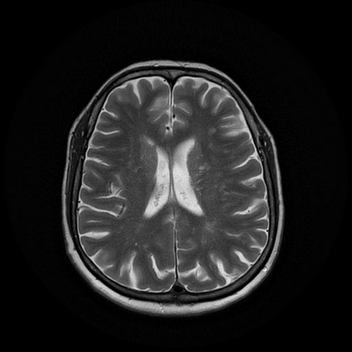 File:Cerebral metastases - melanoma (Radiopaedia 80972-94522 Axial T2 19).jpg