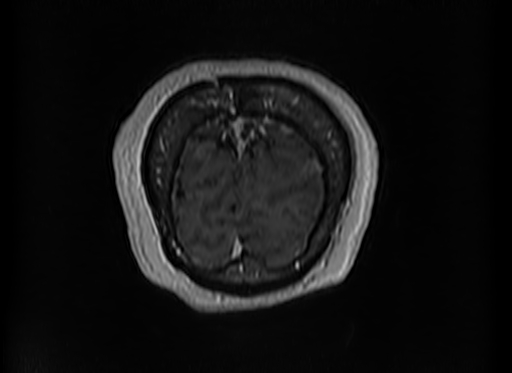 File:Cerebral metastases from lung cancer with amyloid angiopathy and cerebellopontine angle meningioma (Radiopaedia 74306-85191 Coronal T1 C+ 59).jpg