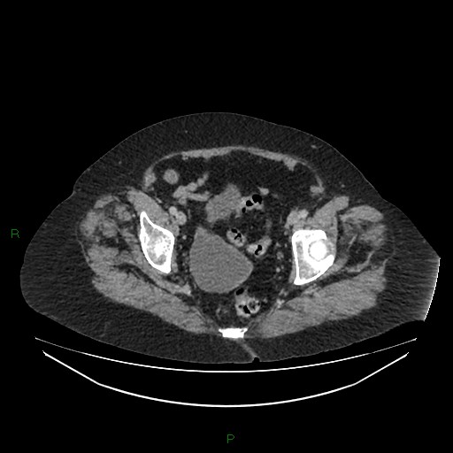 File:Cerebral metastasis from renal cell carcinoma (Radiopaedia 82306-96378 A 171).jpg