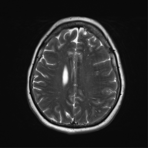File:Cerebral metastasis mimicking glioblastoma (Radiopaedia 69155-78937 Axial T2 29).png
