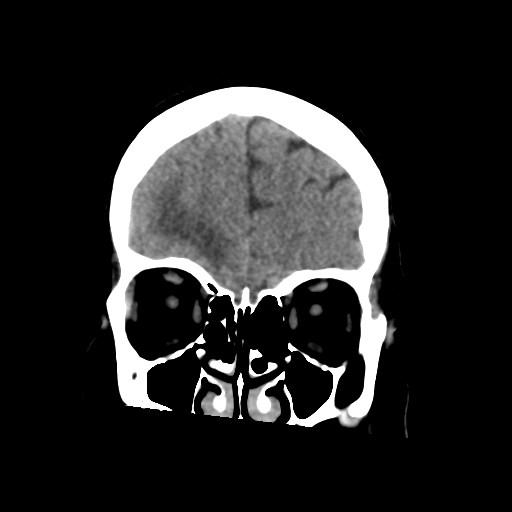Cerebral metastasis to basal ganglia (Radiopaedia 81568-95412 Coronal non-contrast 18).png