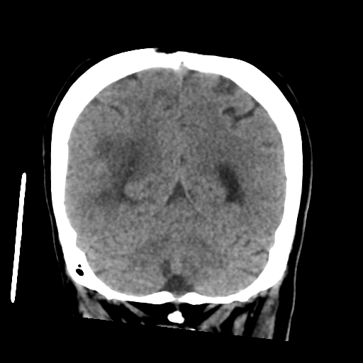 Cerebral metastasis to basal ganglia (Radiopaedia 81568-95412 Coronal non-contrast 50).png