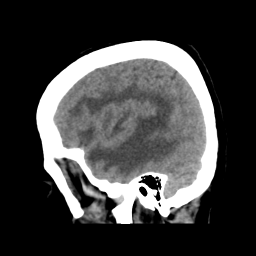 File:Cerebral metastasis to basal ganglia (Radiopaedia 81568-95412 E 16).png