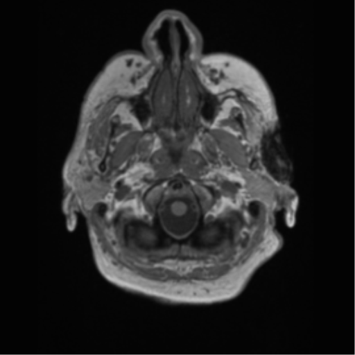 Cerebral metastasis to basal ganglia (Radiopaedia 81568-95413 Axial T1 3).png
