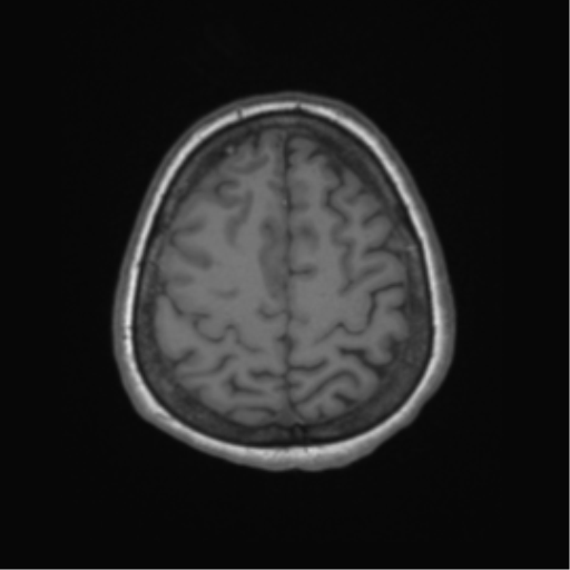 Cerebral metastasis to basal ganglia (Radiopaedia 81568-95413 Axial T1 60).png