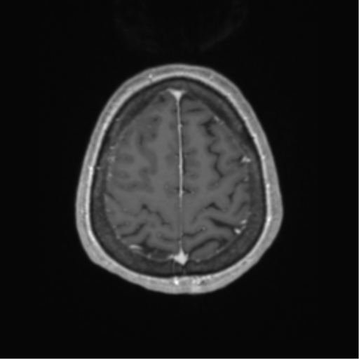 Cerebral metastasis to basal ganglia (Radiopaedia 81568-95413 Axial T1 C+ 63).png
