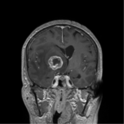 File:Cerebral metastasis to basal ganglia (Radiopaedia 81568-95413 Coronal T1 C+ 31).png