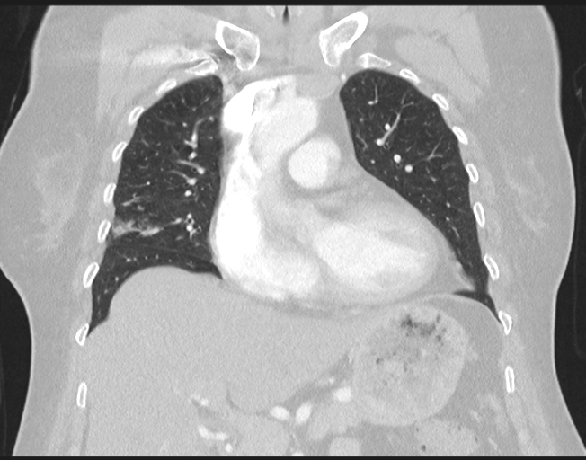 File:Cerebral metastasis to basal ganglia (Radiopaedia 81568-95414 Coronal lung window 35).png