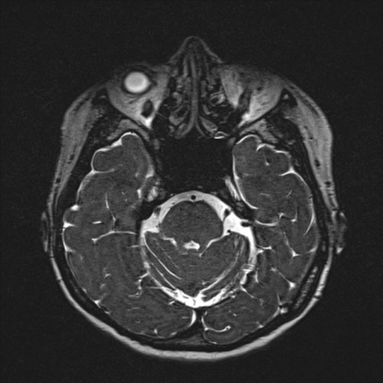 Cerebral ring enhancing lesions - cerebral metastases (Radiopaedia 44922-48817 F 50).jpg