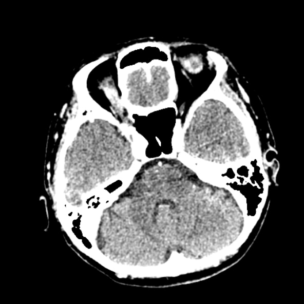 Cerebral ring enhancing lesions - cerebral metastases (Radiopaedia 44922-48818 B 86).jpg