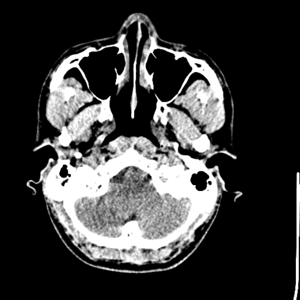 Cerebral toxoplasmosis (Radiopaedia 53993-60131 Axial non-contrast 12).jpg