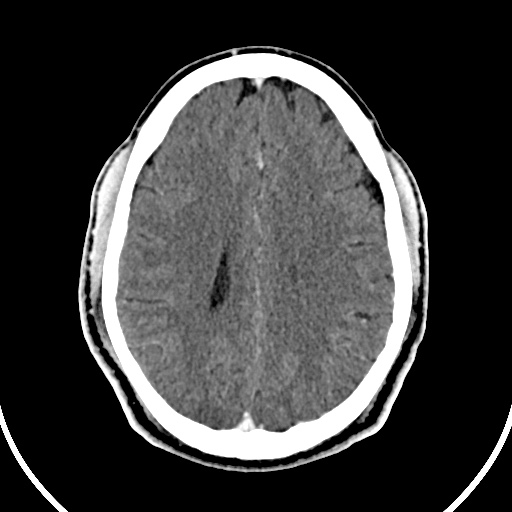 File:Cerebral venous angioma (Radiopaedia 69959-79977 B 65).jpg