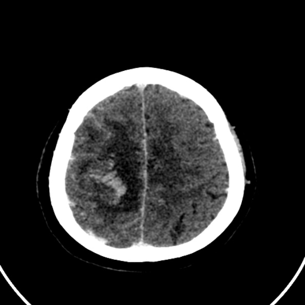 Cerebral venous hemorrhagic infarct from venous sinus thrombosis (Radiopaedia 55433-61883 Axial C+ delayed 33).jpg