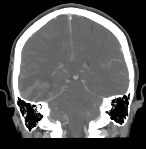 File:Cerebral venous hemorrhagic infarction (Radiopaedia 38461-40550 Coronal MIP VENOGRAM 38).png