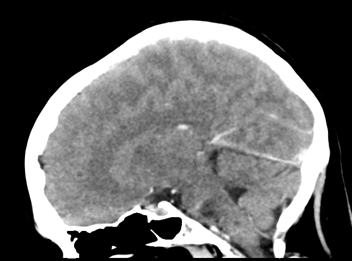 File:Cerebral venous hemorrhagic infarction (Radiopaedia 57576-64538 Sagittal C+ 25).png