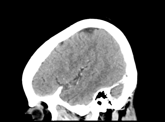Cerebral venous hemorrhagic infarction (Radiopaedia 57576-64538 Sagittal C+ 42).png