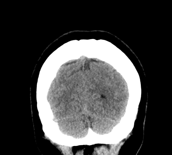 File:Cerebral venous infarct related to dural venous sinus thromboses (Radiopaedia 35292-36804 Coronal non-contrast 32).png