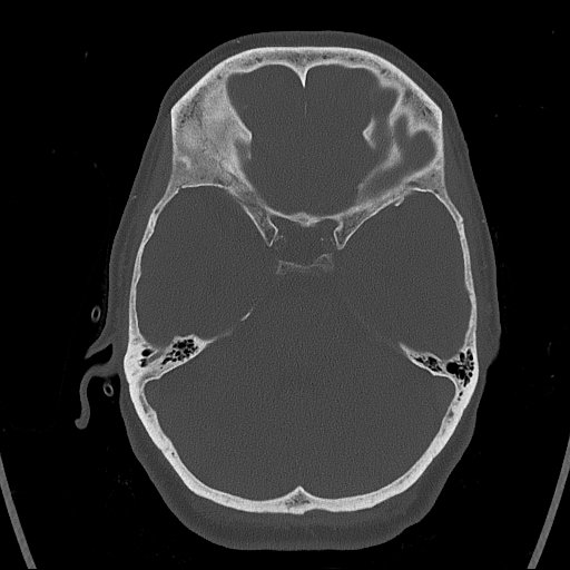 Cerebral venous infarction with hemorrhage (Radiopaedia 65343-74381 Axial bone window 44).jpg