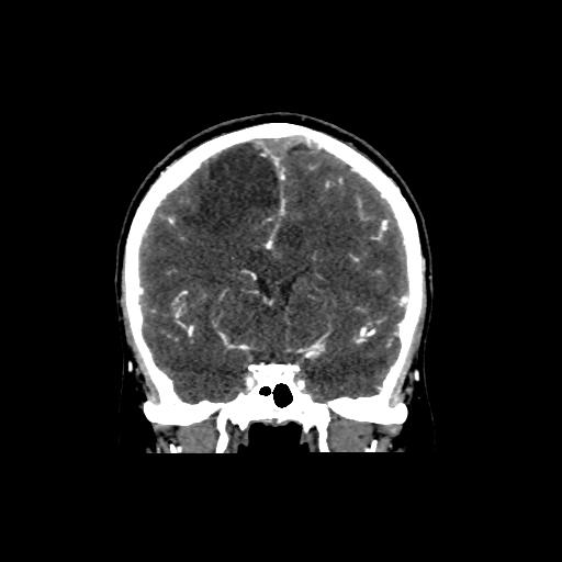 File:Cerebral venous throbmosis - hemorrhagic venous infarction (Radiopaedia 87318-103613 Coronal CT venogram 14).jpg