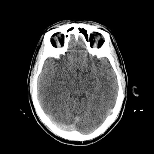 File:Cerebral venous thrombosis (CVT) (Radiopaedia 77524-89685 Axial non-contrast 19).jpg