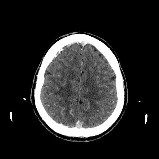 File:Cerebral venous thrombosis (CVT) (Radiopaedia 77524-89685 Axial with contrast 29).jpg