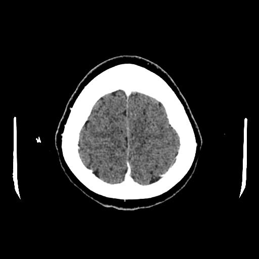 Cerebral venous thrombosis with venous hemorrhagic infarct (Radiopaedia 90354-107660 Axial with contrast 144).jpg