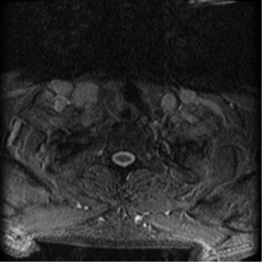 Cervical canal stenosis with cord compression (Radiopaedia 34114-35374 Axial Gradient Echo 4).png