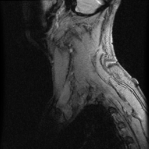 File:Cervical canal stenosis with cord compression (Radiopaedia 34114-35374 D 23).png