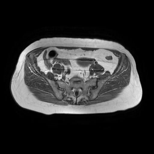 File:Cervical carcinoma (Radiopaedia 67644-77047 Axial T1 6).jpg